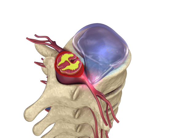 Cervical Radiculopathy treatment