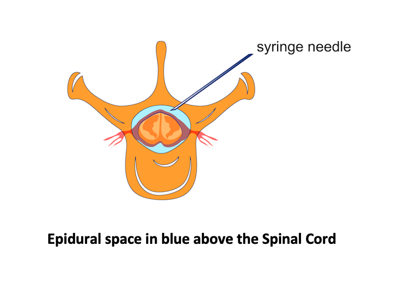 Cervical Epidural steroid injections for Cervical Radiculopathy