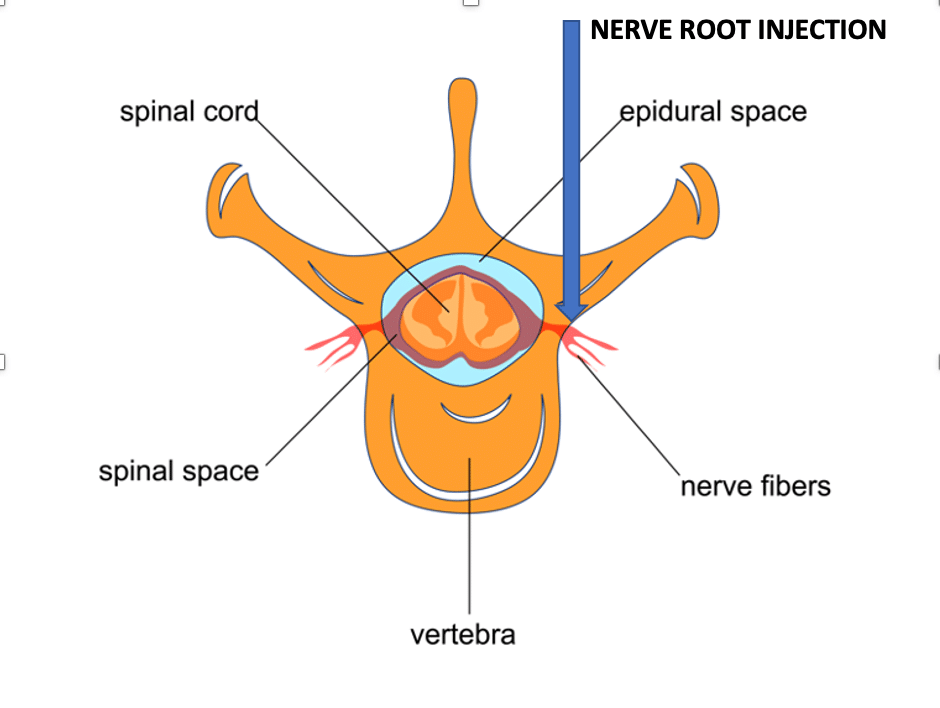 Cervical-Nerve-Root-Injection for Cervical Radiculopathy