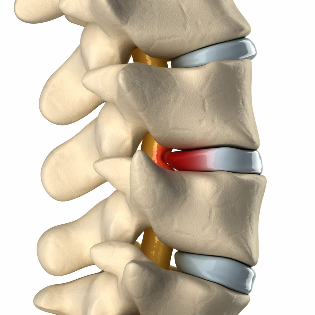 Disc prolapse causing pressure and irritation on the spinal nerve causing Back pain | Spine Surgeon London