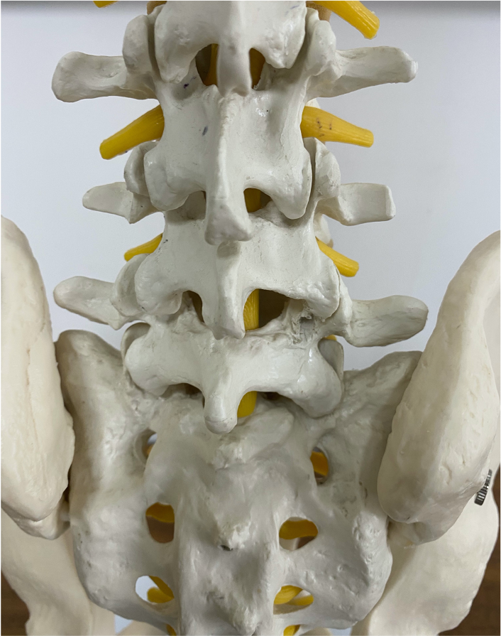 Facet joint inflammation causes Back pain