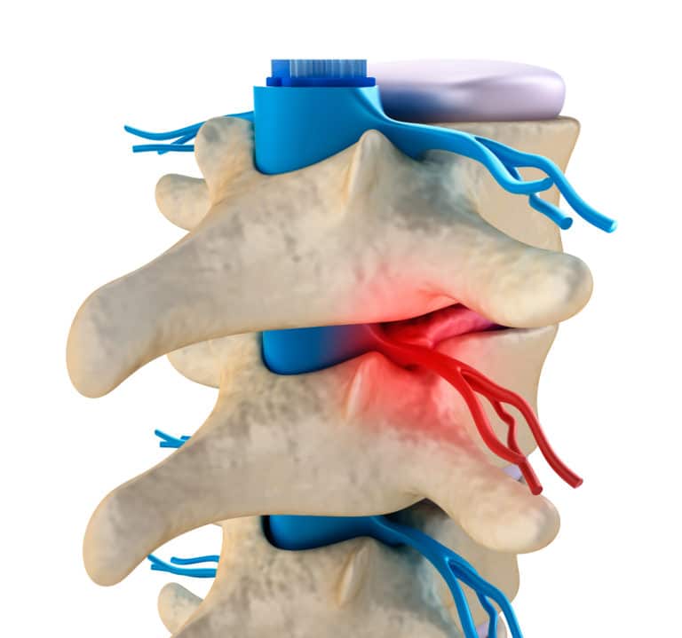 Foraminal Stenosis causing Cervical Radiculopathy