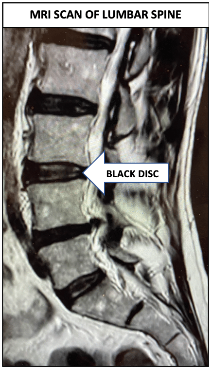 Lumbar Disc Degeneration causing Back pain