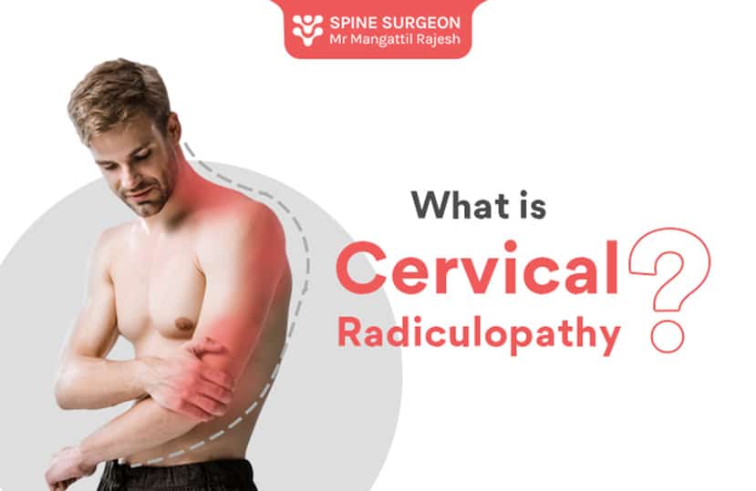 What is Cervical radiculopathy?