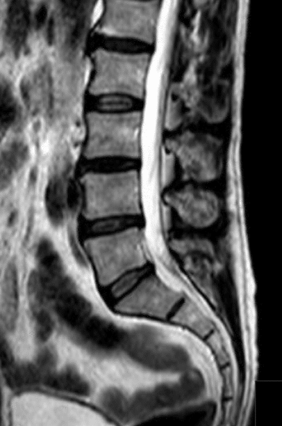 Back-Normal MRI-scan | Mangattil Rajesh | Spine Surgeon London |