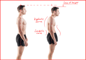 Crouching or stooping posture while standing causing Back pain | Mangattil Rajesh | Spine Surgeon London |