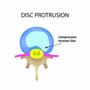 Lumbar Disc prolapse with a pinched nerve causing Back pain | Mangattil Rajesh |Spine Surgeon London |