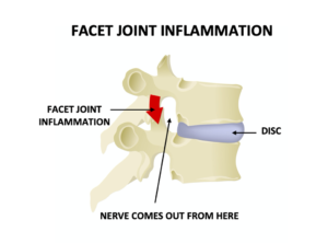 Facet joint Inflammation causing a pinched nerve | Low back pain | Mangattil Rajesh | Spine Surgeon London |