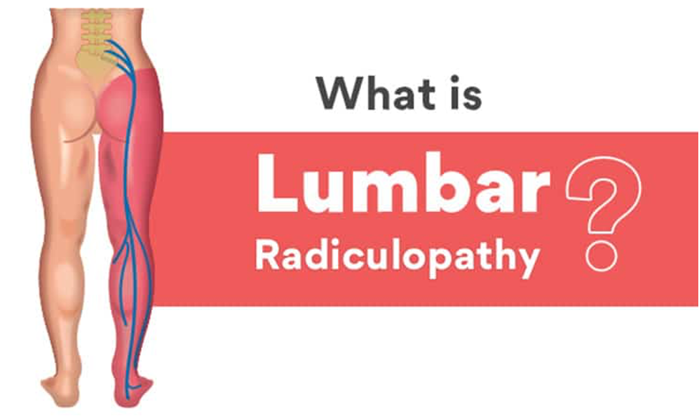 Low Back and Leg Pain is Lumbar Radiculopathy