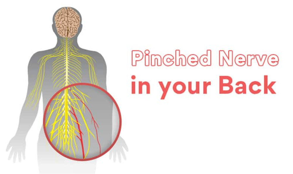 pinched nerve in leg