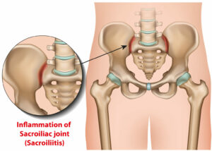 Sacroiliac joint inflammation causing pinched nerve and Back pain | Mangattil Rajesh | Spine Surgeon London |