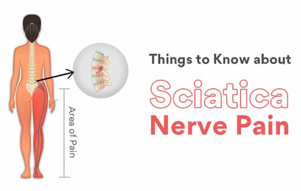 Sciatica pain causes, symptoms and fast relief with exercises