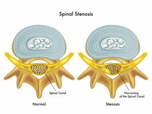 Spinal Stenosis causing pinched nerve L Low back pain | Mangattil Rajesh | Spine Surgeon London |