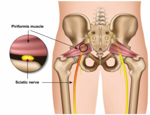 Piriformis syndrome causing a pinched nerve and low back pain | Mangattil Rajesh | Spine Surgeon London |