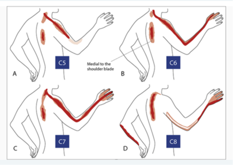 Nerve Root Symptoms for Cervical Radiculopathy Shows Nerve Root Symptoms for Cervical Radiculopathy | Mangattil Rajesh | Spine Surgeon London | www.spinesurgeon.london