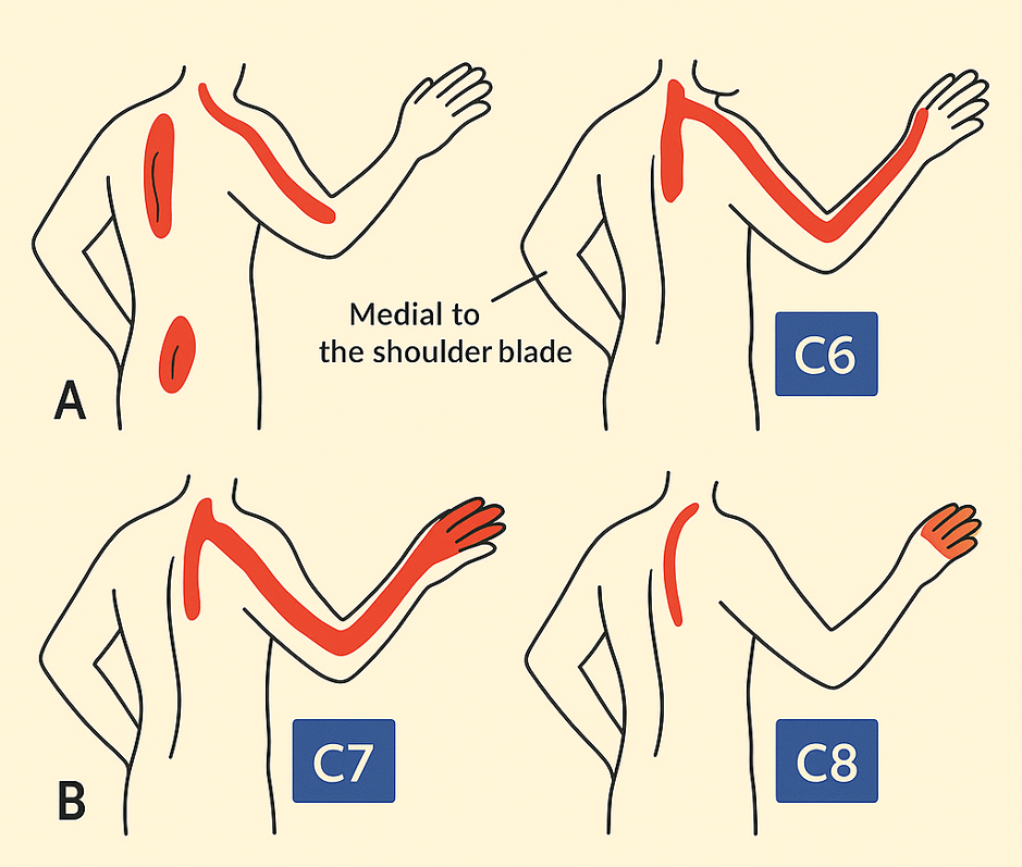Root levels for Cervical Radiculopathy Shows Nerve Root Symptoms for Cervical Radiculopathy | Mangattil Rajesh | Spine Surgeon London | www.spinesurgeon.london